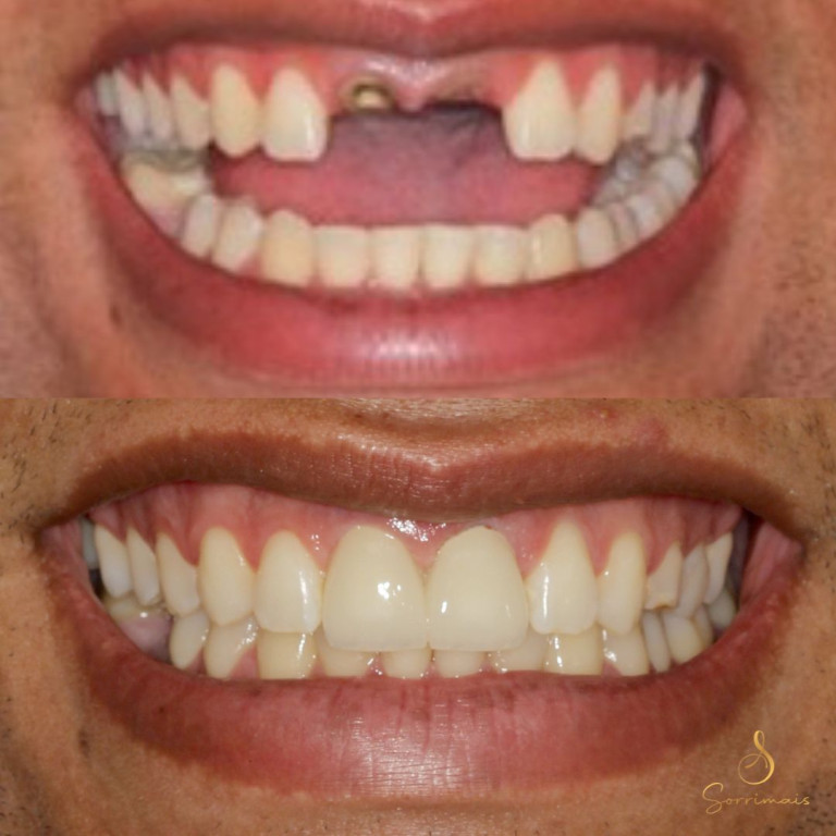 implante_dentario_area_estetica_3