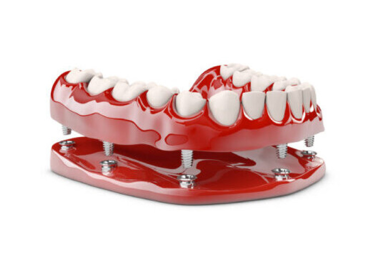 Protocolo Sobre Implante