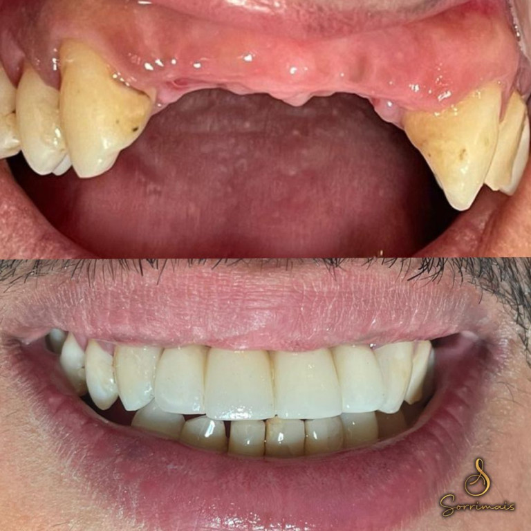 protese_fixa_estilo_protocolo_2