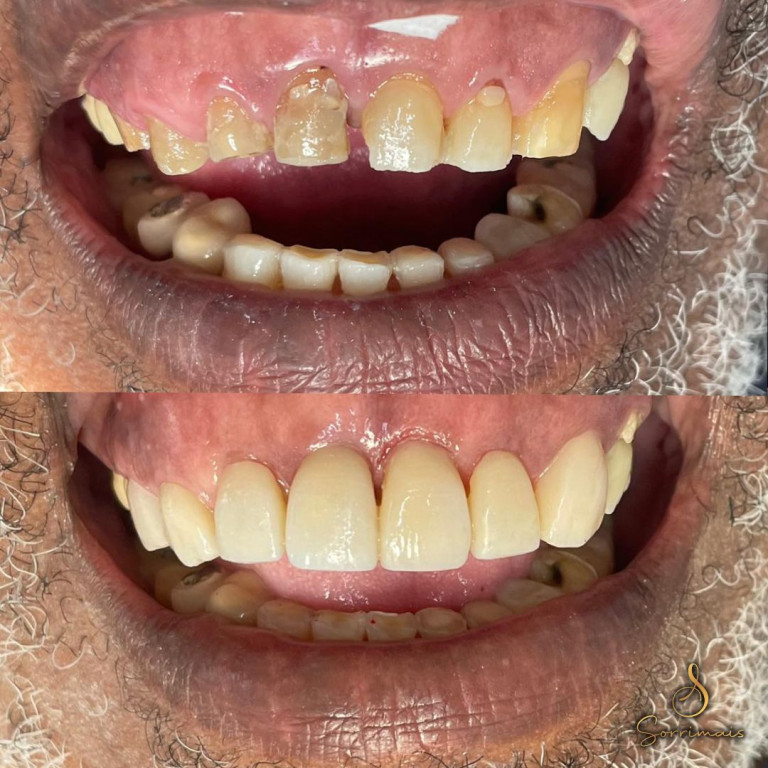 facetas de porcelana 2