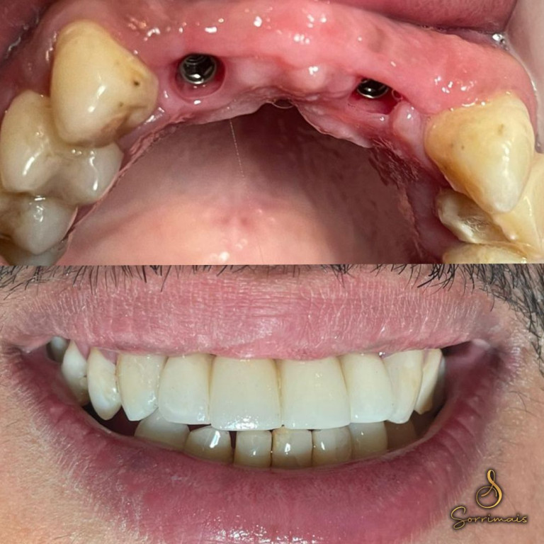 protese fixa estilo protocolo