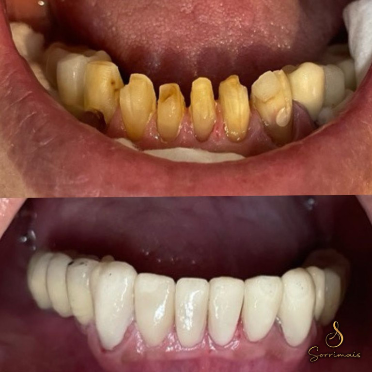 facetas de porcelana